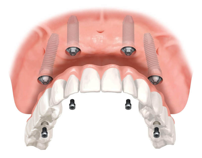 Тонкости имплантации зубов на верхней челюсти